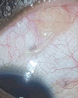 NEOflorax a aidé à se débarrasser d'un ver dans l'œil